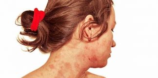 Eczema Treatment; Best Natural Remedies Eczema Treatment