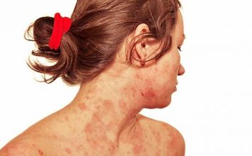 Eczema Treatment; Best Natural Remedies Eczema Treatment